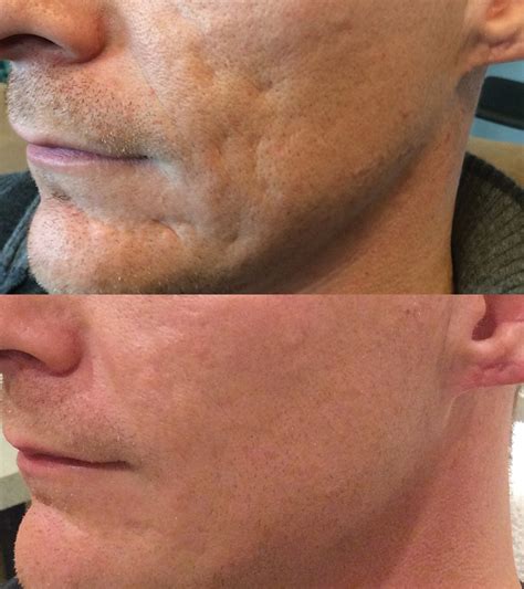 Bellafill Treatment For Reducing Acne Scars Fda Cleared