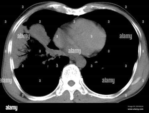 Early Lung Cancer Ct Scan