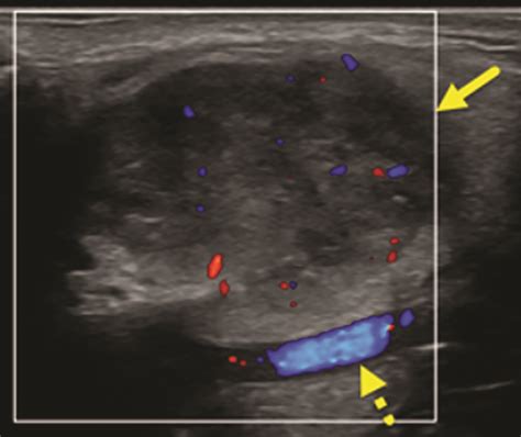 Pleomorphic Adenoma Of The Parotid Gland Applied Radiology