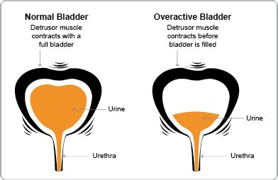 Overactive Bladder (OAB) - ASUI