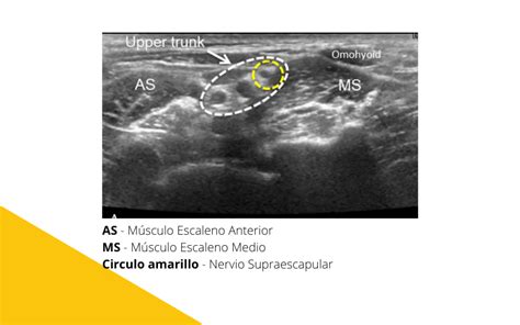 Nervio Supraescapular Y Ecograf A Tempo Formaci N