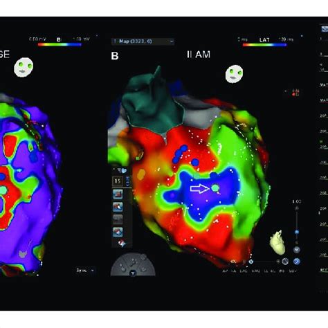 Electroanatomic Carto Map Of The Patient S Left Ventricle A Voltage