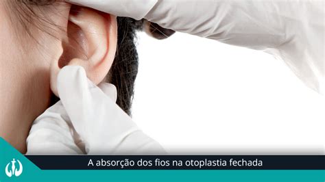 A Absor O Dos Fios Na Otoplastia Fechada Cirurgia Pl Stica Bh