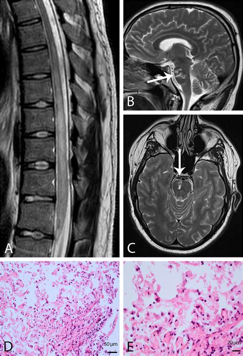 Frontiers Case Report A Spinal Ischemic Lesion In A Year Old