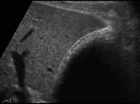 Abdomen And Retroperitoneum 12 Gallbladder And Bile Ducts Case 12