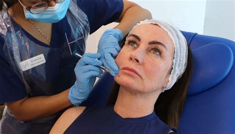 marionette lines  academy clinic