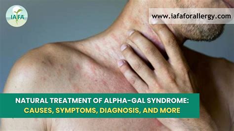 Natural Treatment Of Alpha Gal Syndrome Causes Symptoms Diagnosis