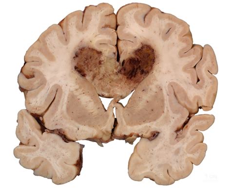 Glioblastoma Multiforme (GBM) - Stepwards