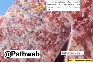 Lung Lobar Pneumonia Nus Pathweb Nus Pathweb