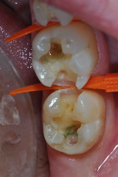 Caries Detection Dye Web - Lee Ann Brady, DMD's Dental Blog