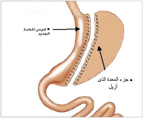 عملية تكميم المعدة فوائد عملية تكميم المعدة لإنقاص الوزن صقور الإبدآع