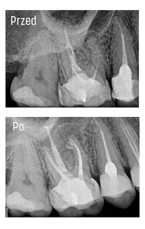 Na Czym Polega Leczenie Kanałowe Pod Mikroskopem Klinika Kwiatek