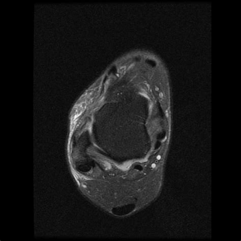 Radiology Cases: Chronic ATFL Tear and Lateral Gutter Synovitis