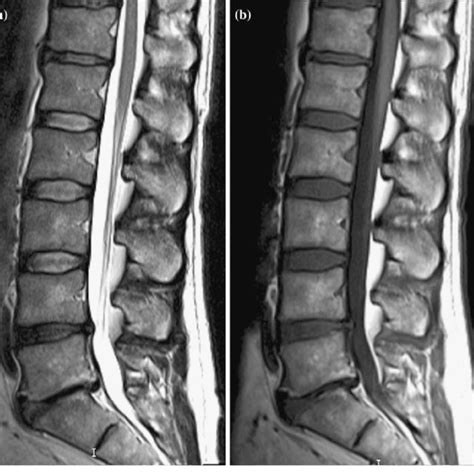 Lumbar Spine Sagittal View