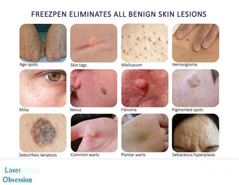 Skin Lesion Removal Services | Lasser Obsession