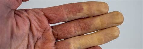 Raynaud Syndrom Adäquate Therapie Kann Spätere Sklerodermie Verhindern