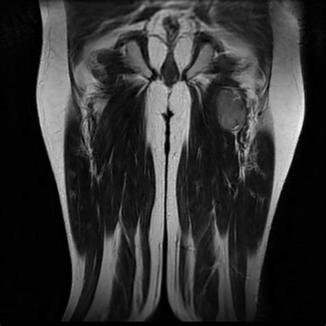 Thigh Synovial Sarcoma Image