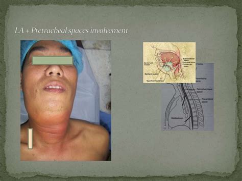 Complex Odontogenic Infection