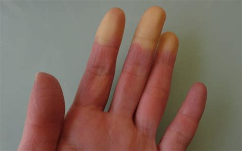 Fenómeno De Raynaud Una Afección De Los Vasos Sanguíneos