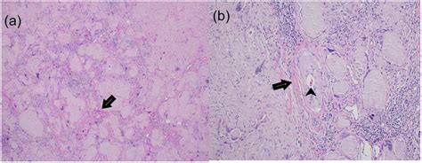 First Case Of Nodular Localized Primary Cutaneous Amyloidosis Treated With Bortezomib And