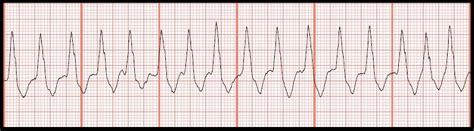 Wide Complex Ivcd Doplottery