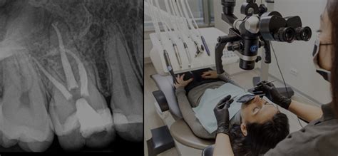 Treatment Of Root Canals Using Microscope Endodontics