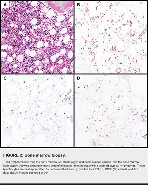 PDF A Case Of Secondary Hemophagocytic Lymphohistiocytosis In A