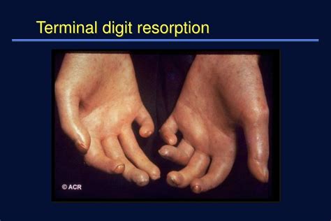 PPT Scleroderma Systemic Sclerosis PowerPoint Presentation Free