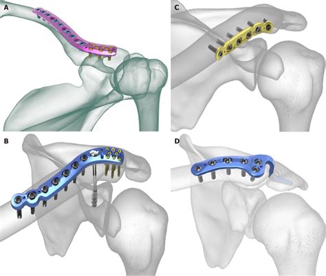 Clavicular Fracture Clavicle Fractures • LITFL • Trauma Library