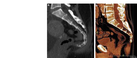 Imaging In Degenerative Spine Pathology Pdf Download Available