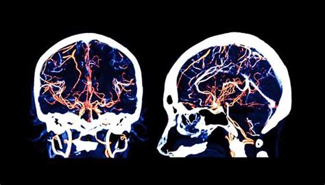 Microsurgical Clipping For Brain Aneurysms Johns Hopkins Medicine