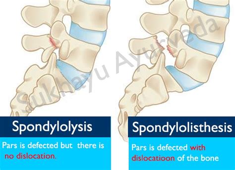 Spondylolistehsis Where One Bone Slips On The Other Know Everything