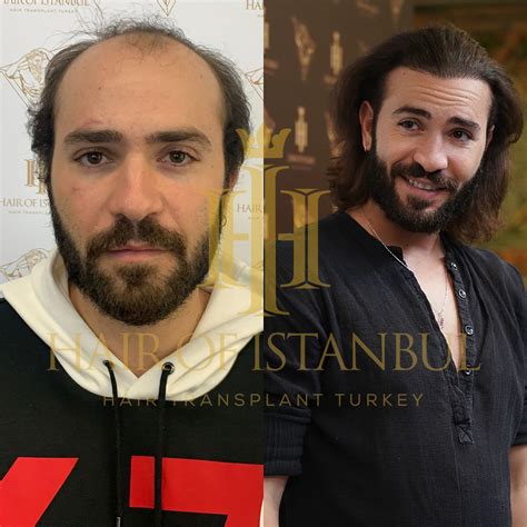 Hair of Istanbul FUE Hair Transplant in Turkey