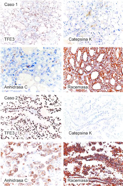 Estudio Inmunohistoqu Mico Comparativo De Ambos Casos El Denominador