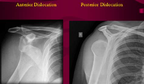 Ortho Exam Shoulder Flashcards Quizlet