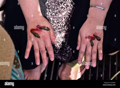 A patient receives leech therapy. Every year traditional health workers ...