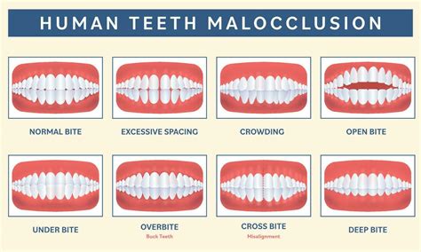 Malocclusion Of The Human Teeth Infographic Icon Set Over Peach