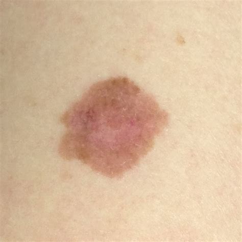 Melanoma On Arm