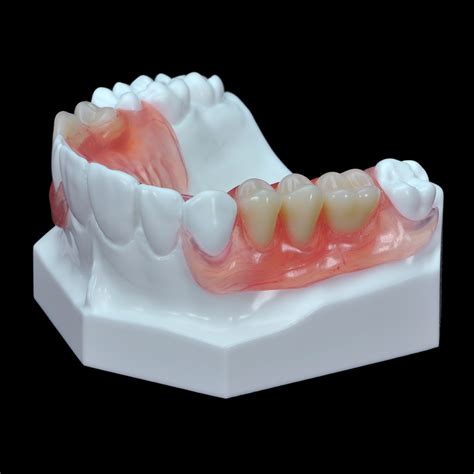 GD-07 Flexible Partial Upper Denture | Paradigm Dental Models