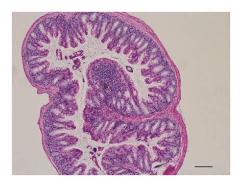 Lymphoid Follicles And Inflammatory Infiltrate A Lymphoid Follicles Download Scientific