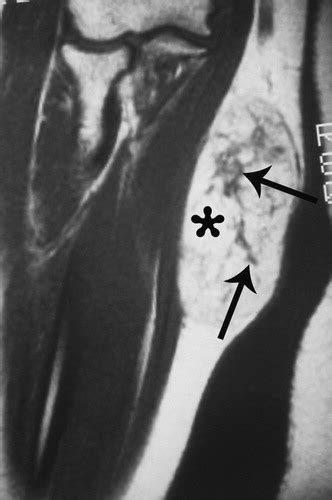 Imaging Of Musculoskeletal Liposarcoma With Radiologic Pathologic