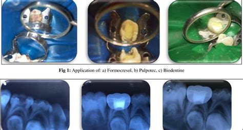 [pdf] Comparative Evaluation Of Success Of Pulpotomy In Primary Molars