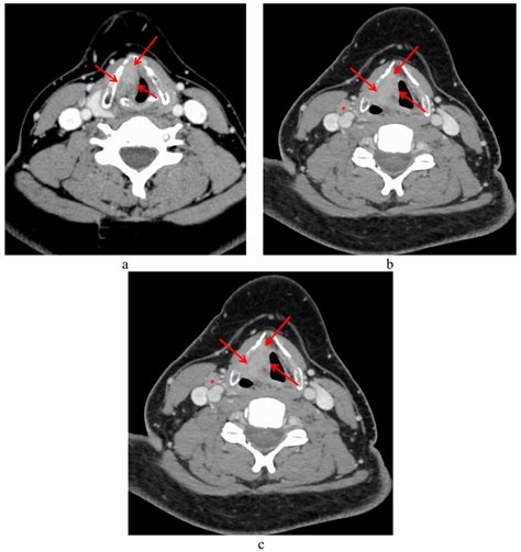 Ct Scan Of A 36 Year Old Patient With T3 Laryngeal Cancer Red Arrows