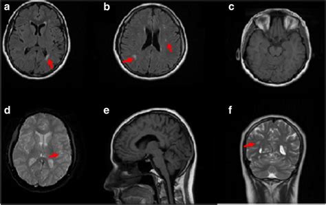 Subcortical Millimetric Gliotic Foci Exist In Bilateral Periventricular Download Scientific