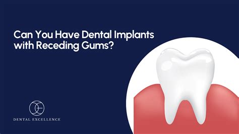 Do Dental Implants Hurt Understanding The Pain Involved