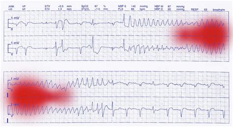 Ecg Trace Of A Heart Attack Photograph By Doncaster And Bassetlaw