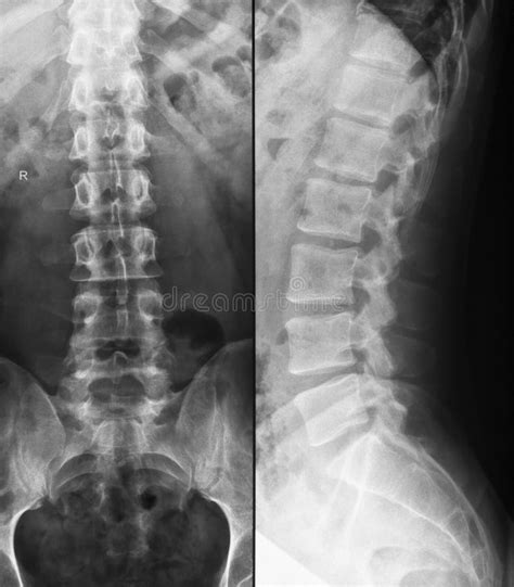 Lumbar Spine X Ray