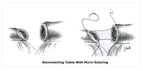 What Is Tubal Reversal Surgery Or Anastomosis Nccrm