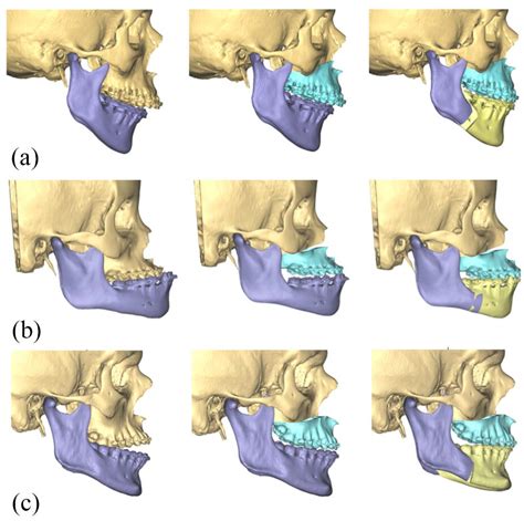 Three Dimensional Virtual Surgical Planning D Vsp In Orthognathic