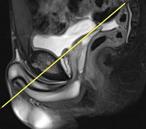 The Copenhagen Standardised MRI Protocol To Assess The Pubic Symphysis